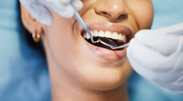 Teeth Whitening in MD