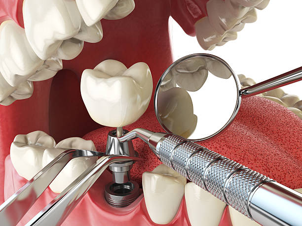 Best Root Canal Emergency Dentist  in Derwood, MD